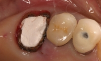 ひどい虫歯の治療 写真1
