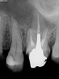 抜歯しない治療 症例12 見落とし根管