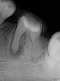 抜歯しない治療 症例14 石灰化根管
