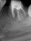 抜歯しない治療 症例14 石灰化根管
