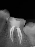 抜歯しない治療 症例15 抜髄根管