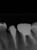 抜歯しない治療 症例18 パーフォレーションリペアー