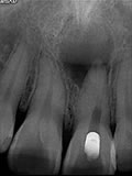 抜歯しない治療 症例20 外傷による外部吸収とパーフォレーションリペアー