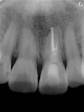 抜歯しない治療 症例20 外傷による外部吸収とパーフォレーションリペアー