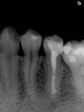 抜歯しない治療 症例22 アペキシフィケーション下顎小臼歯