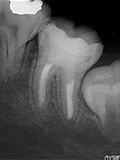 抜歯しない治療 症例23 アペキシフィケーション下顎大臼歯