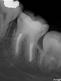 抜歯しない治療 症例23 アペキシフィケーション下顎大臼歯
