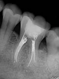 抜歯しない治療 症例26 石灰化根管その２